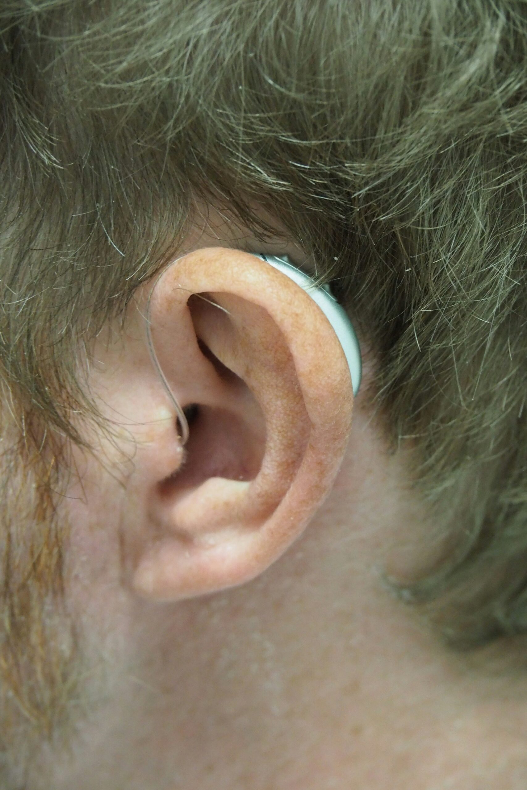 Oreille avec appareil auditif représentant la solution RIC